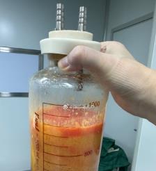西藏水动力吸脂手术要做多久？